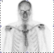 ACJ OA Hot Bone Scan